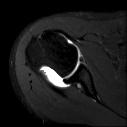 Large Hill Sachs MRI